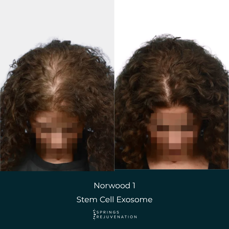 Norwood 1 Stem Cell Exosome